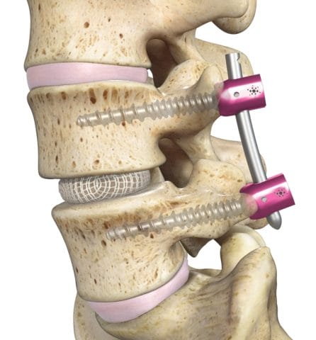 Spineology OptiMesh® Expandable Interbody Fusion System