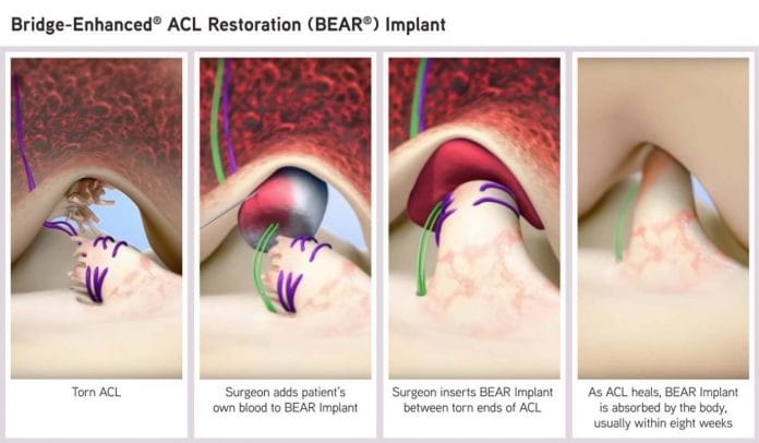 Bear Implant Granted Fda De Novo Approval For Treatment Of Acl Tears