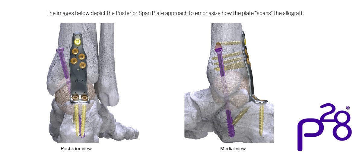 Paragon 28 Increases its Robust Hindfoot Fusion Plating Offering, Launching the Silverback™ Span Plating System