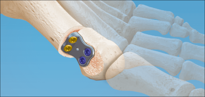 CoLink Vallux Active Bunion Launches Reports In2Bones Global