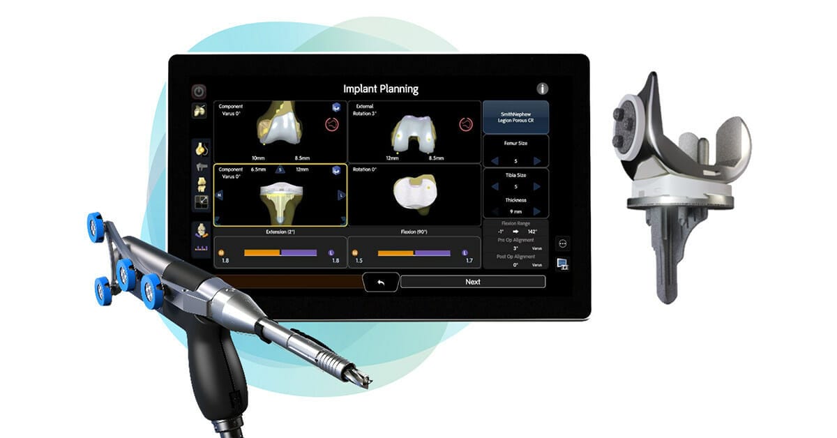 SmithNephew announces first robotic assisted surgery using its LEGION™ CONCELOC™ Cementless Total Knee System news
