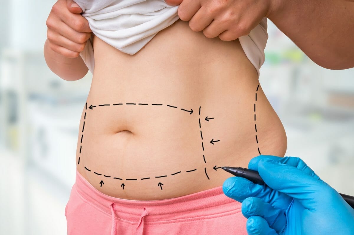How Tummy Tuck Sydney Restores Your Body Contour