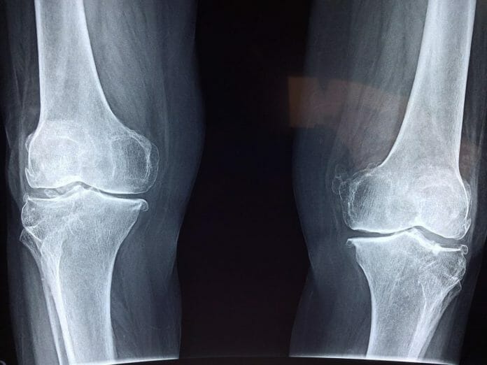 Knee Injuries From a Car Accident: A Complete Guide