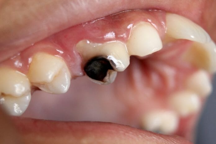 What Are The Five Causes of Tooth Decay?