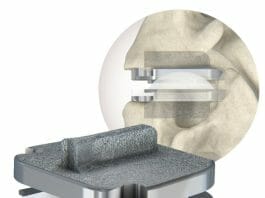 Centinel Spine® Announces First Commercial Use of prodisc® C SK Cervical Total Disc Replacement Product