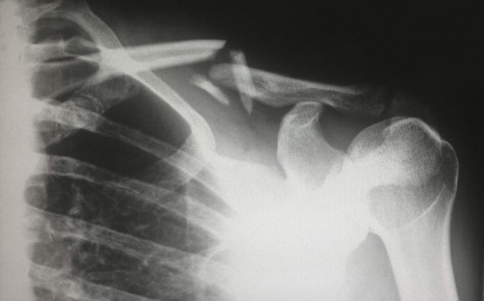 How to Properly Heal Broken Bones: 6 Essential Tips to Follow