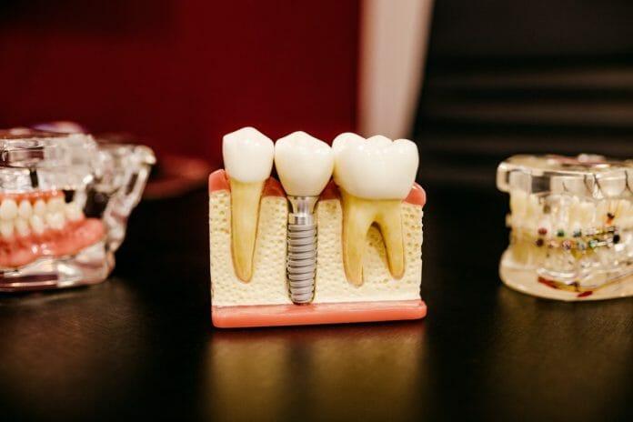 Dental Implant Services in Phoenix