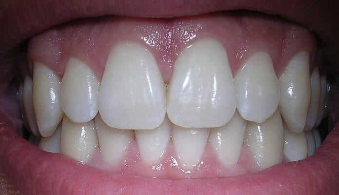 Maintain Dental Hygiene
